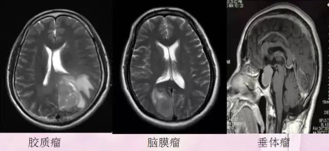 核磁共振能看出来哪些病症,核磁共振可以检查良恶性吗