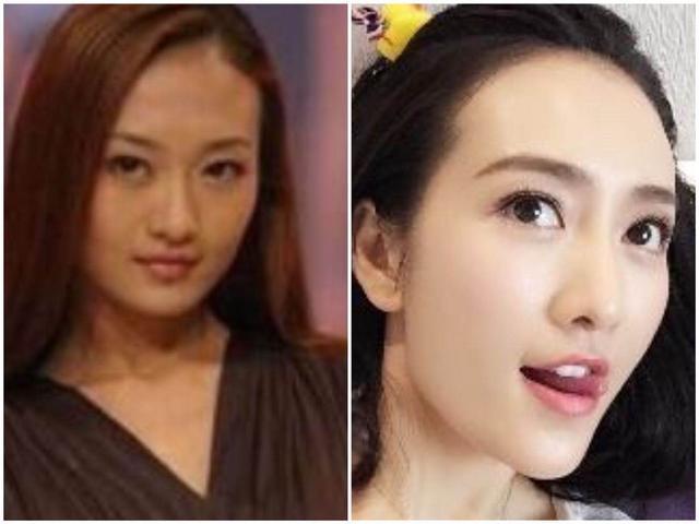 微整形美白针,微整形是永久的吗