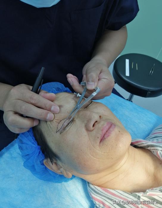 双眼皮提眉一起做半年效果,双眼皮提眉一起做几天能热敷