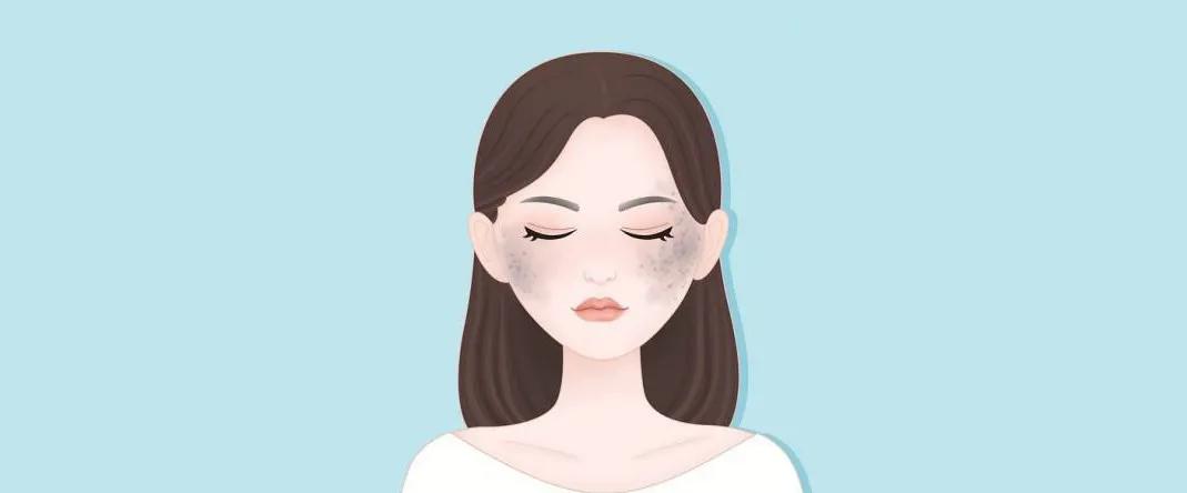 宝宝有太田痣要如何治疗,小孩做完太田痣的注意事项