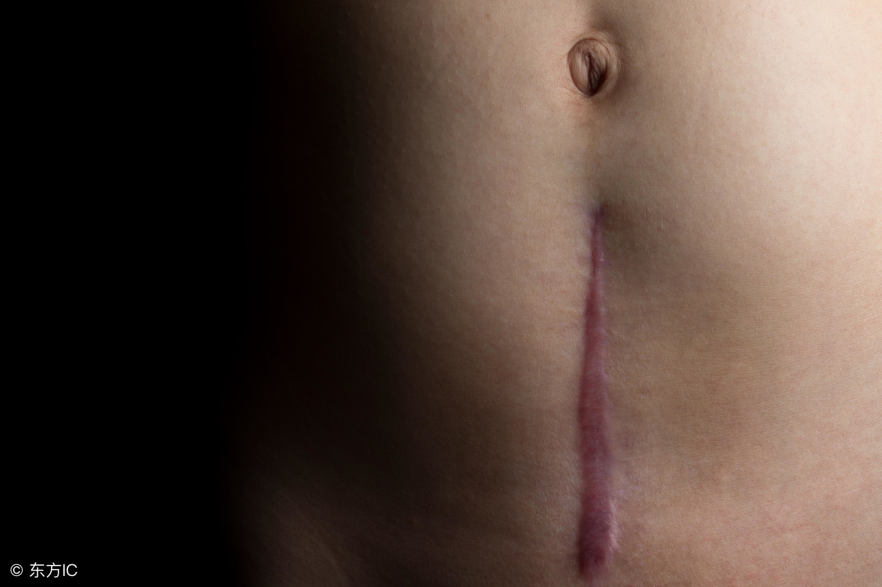 剖腹产横切好还是竖切好？产后伤口如何护理呢?准妈妈注意了