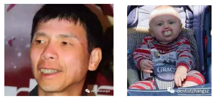 深覆合加深覆盖如何矫正,深覆合深覆盖同时存在如何矫正