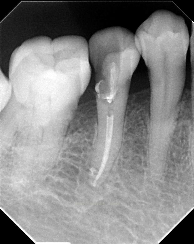 牙髓牙神经位置图,牙髓牙神经在哪里