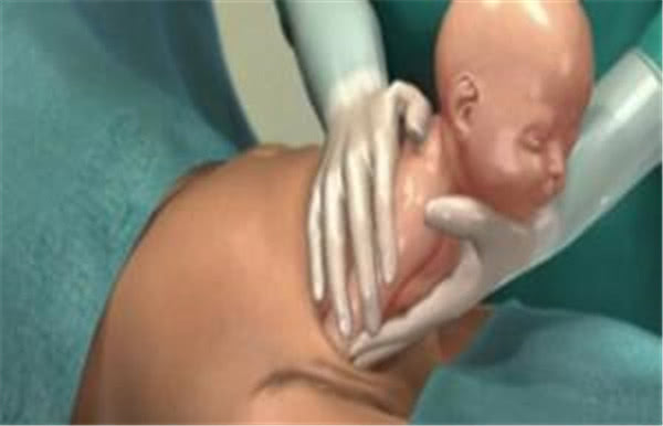 第一胎顺产第二胎剖腹产痛吗,剖腹产有多痛顺产有多痛