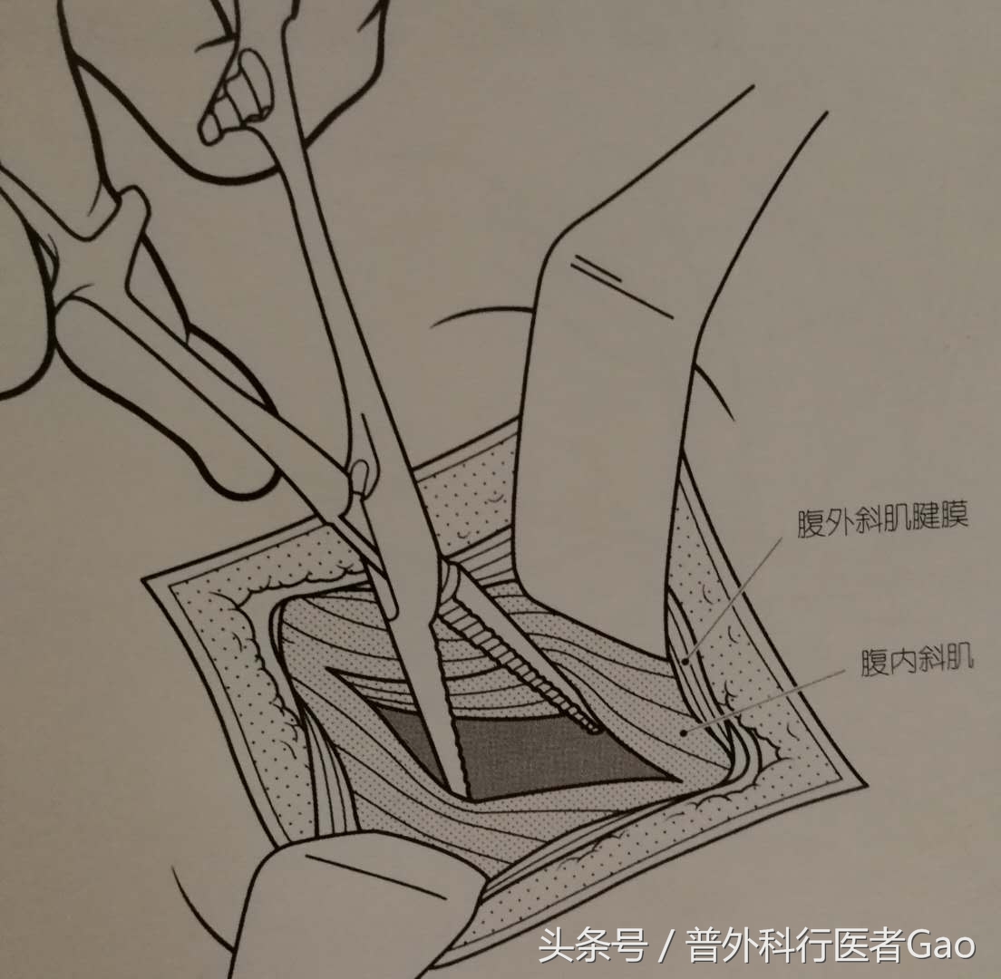 杏仁：一图一话全面解析阑尾的切除过程（干货，不懂医也学习了）