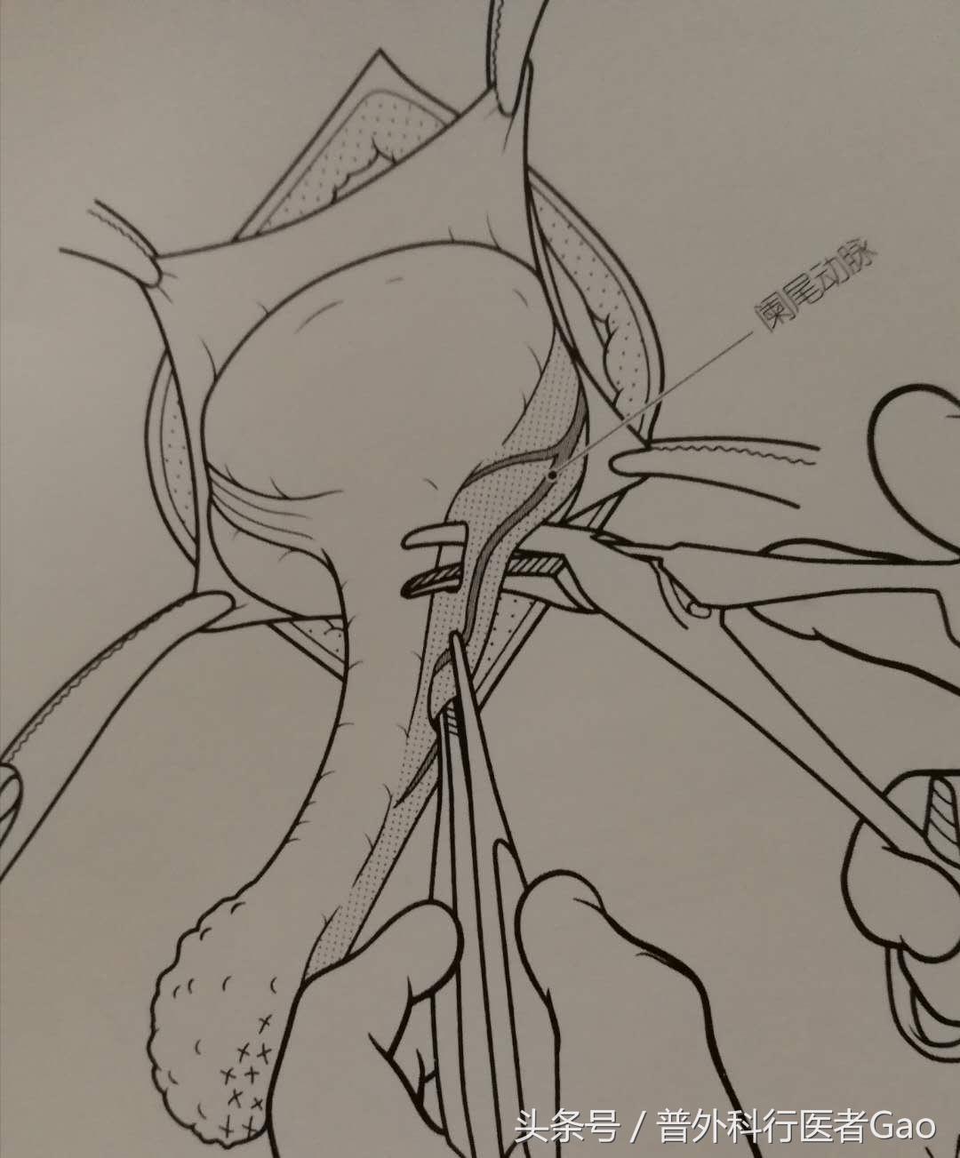杏仁：一图一话全面解析阑尾的切除过程（干货，不懂医也学习了）