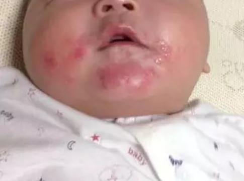 宝宝得了口水疹,口水疹可以抹口水疹膏吗