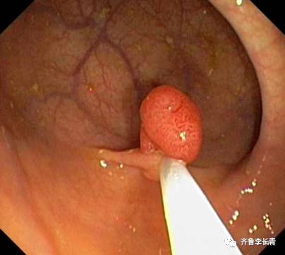 胃息肉几乎每个人都有,查出胃息肉不用怕7个问题了解它