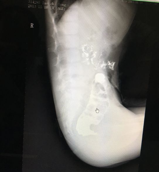 东莞男婴生下来没有肛门!愁坏了父母,憋坏了孩子……医生……