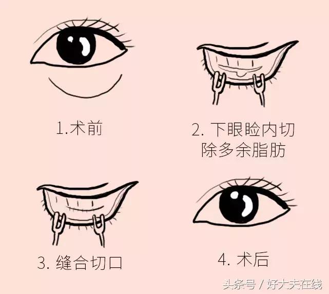 眼袋泪沟怎么去除男生,怎么去除眼袋和泪沟黑眼圈