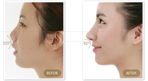 花了30万整的鼻子,花了10万整的鼻子