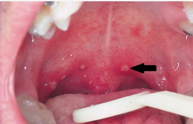 小孩嘴唇鹅口疮什么样,小孩长鹅口疮是缺维生素多少