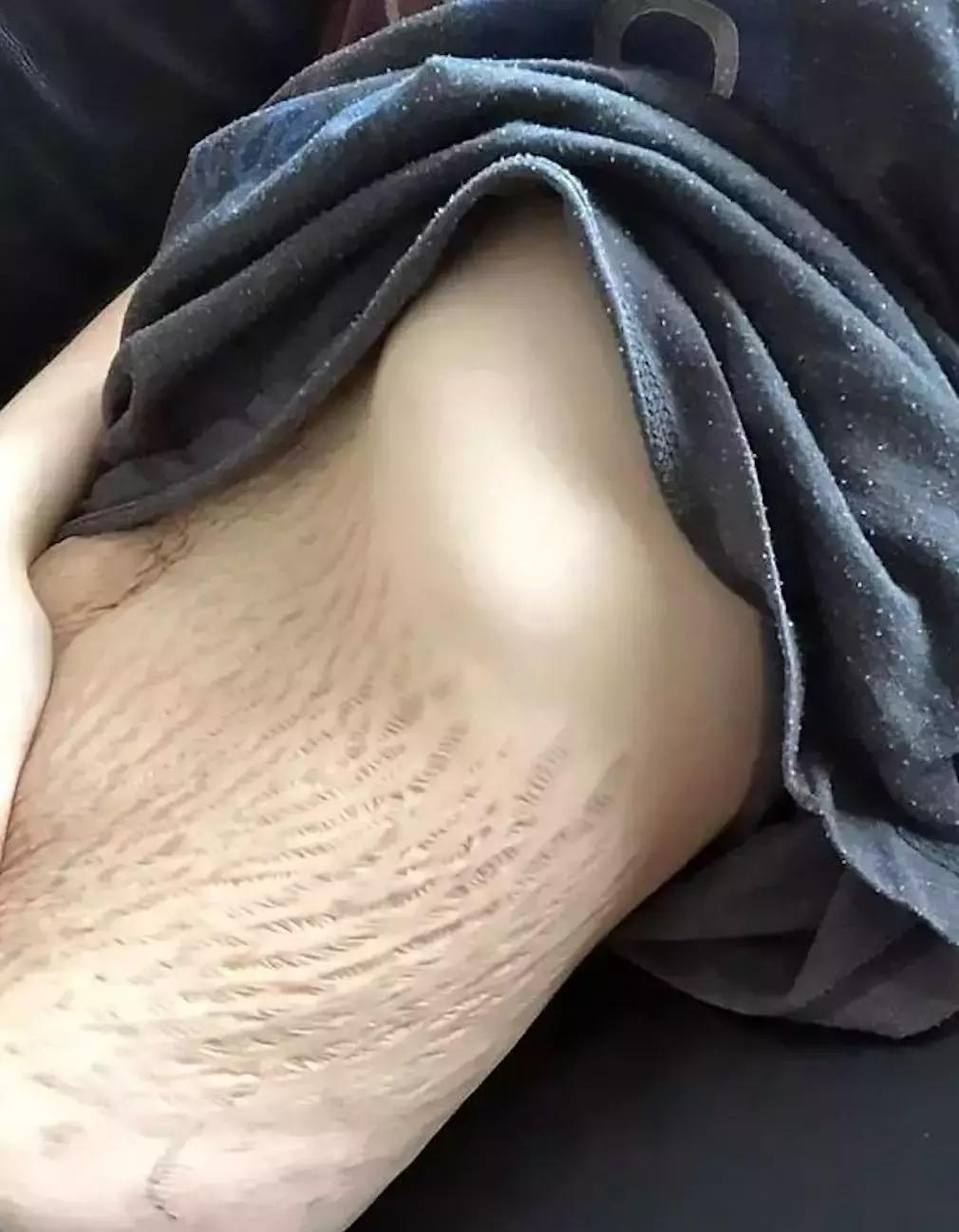 生完后妊娠纹严重的肚子照片,生完后肚子上妊娠纹特别严重