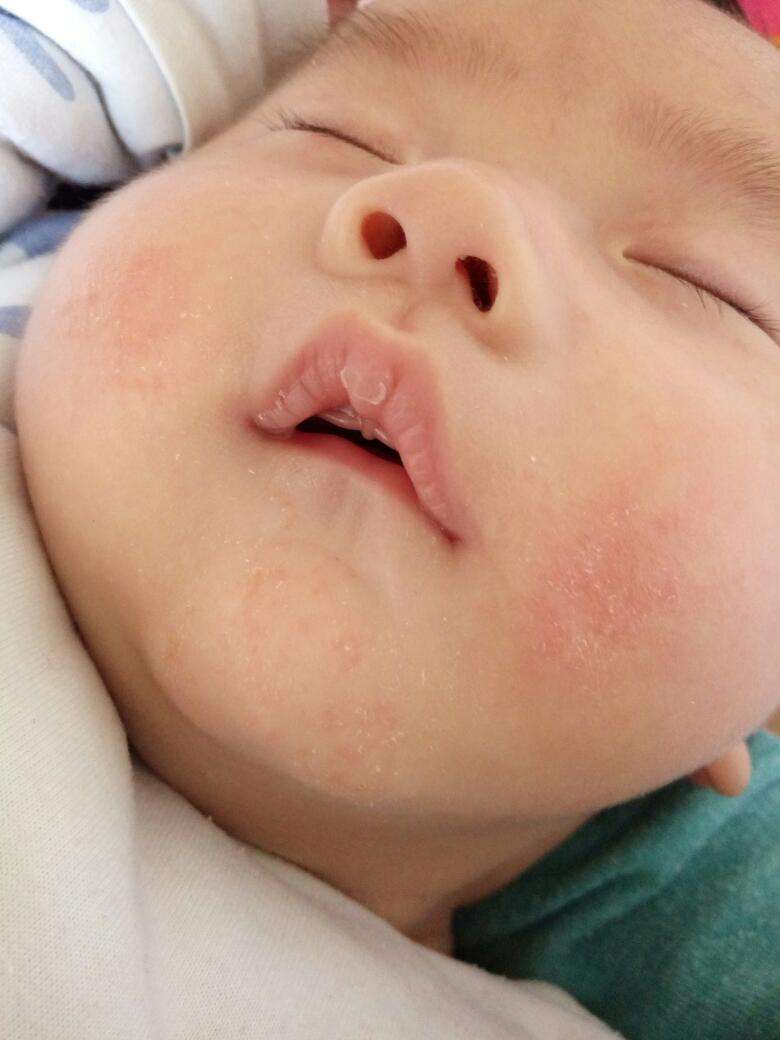 不同部位的湿疹怎么治疗,湿疹5个护理方法大家一起看一看