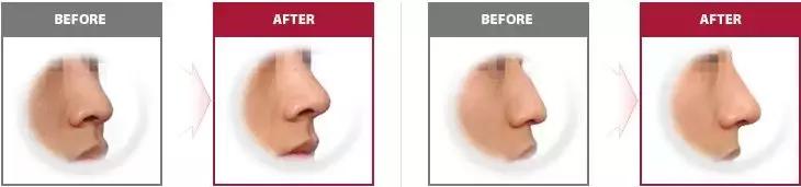 选哪种硅胶隆鼻既经济又实惠,现在都用什么形状的硅胶隆鼻