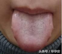 孕妇孕吐脾胃虚弱要注意什么,怀孕孕吐厉害跟肠胃有关吗