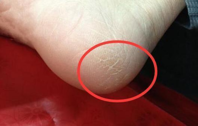 脚裂个口子总是不愈合,脚跟裂怎么办