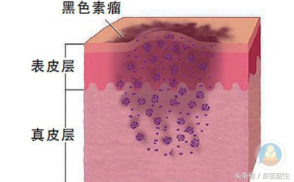 恶性黑色素瘤有活二十年的吗,恶性黑色素瘤为什么致死