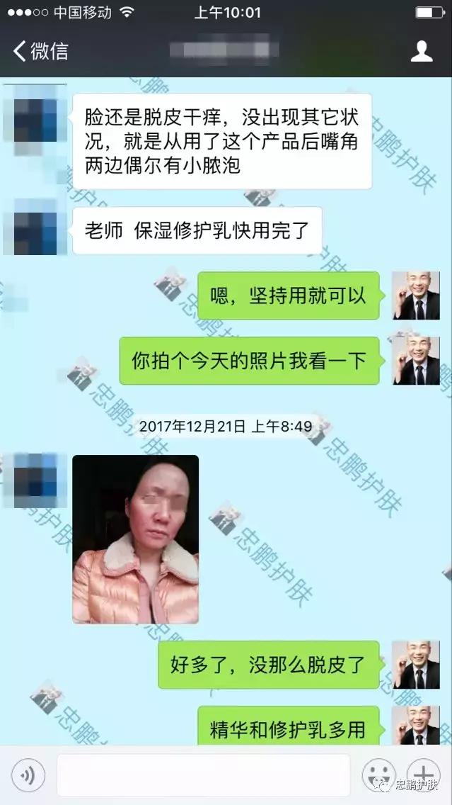 激素脸发红发热脱皮怎么办呢,激素脸为什么会扩散到脖子上代谢