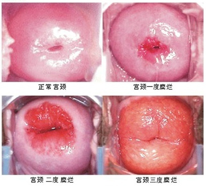 一条棉条引发的惨案,一根棉条引发的惨案