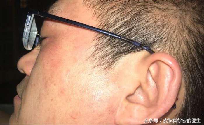 过敏性皮肤很可怕吗,脸皮肤过敏了怎么办最快方法