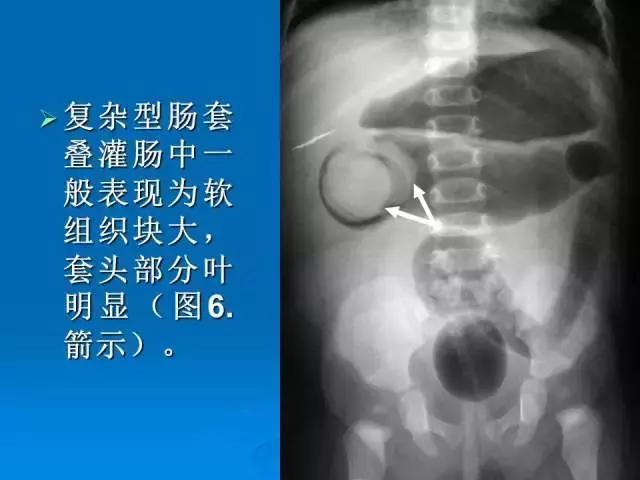 小儿肠套叠空气灌肠需要注意事项,儿童肠套叠空气灌肠要不要住院