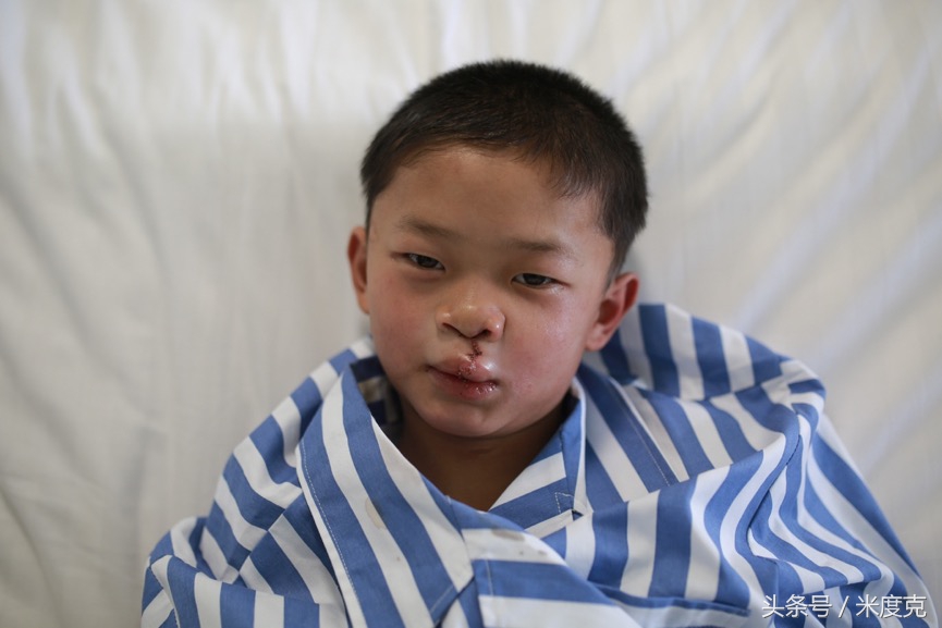 唇腭裂变帅,变帅的孩子