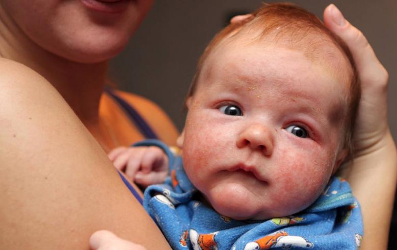 宝宝屁股有尿布疹怎么治疗,湿疹引起的尿布疹