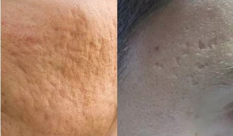 皮肤科修复痘坑大全,痘印痘坑修复皮肤科医生