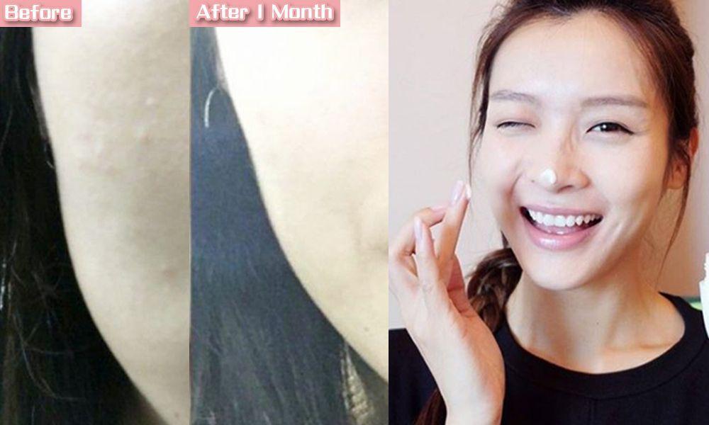 娥罗纳英祛痘印效果好吗,娥罗纳英软膏可以去黑头吗