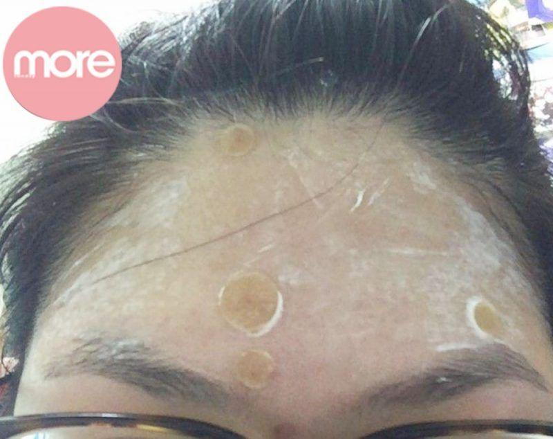 娥罗纳英软膏可以去黑头吗,娥罗纳英软膏祛闭口粉刺可以吗