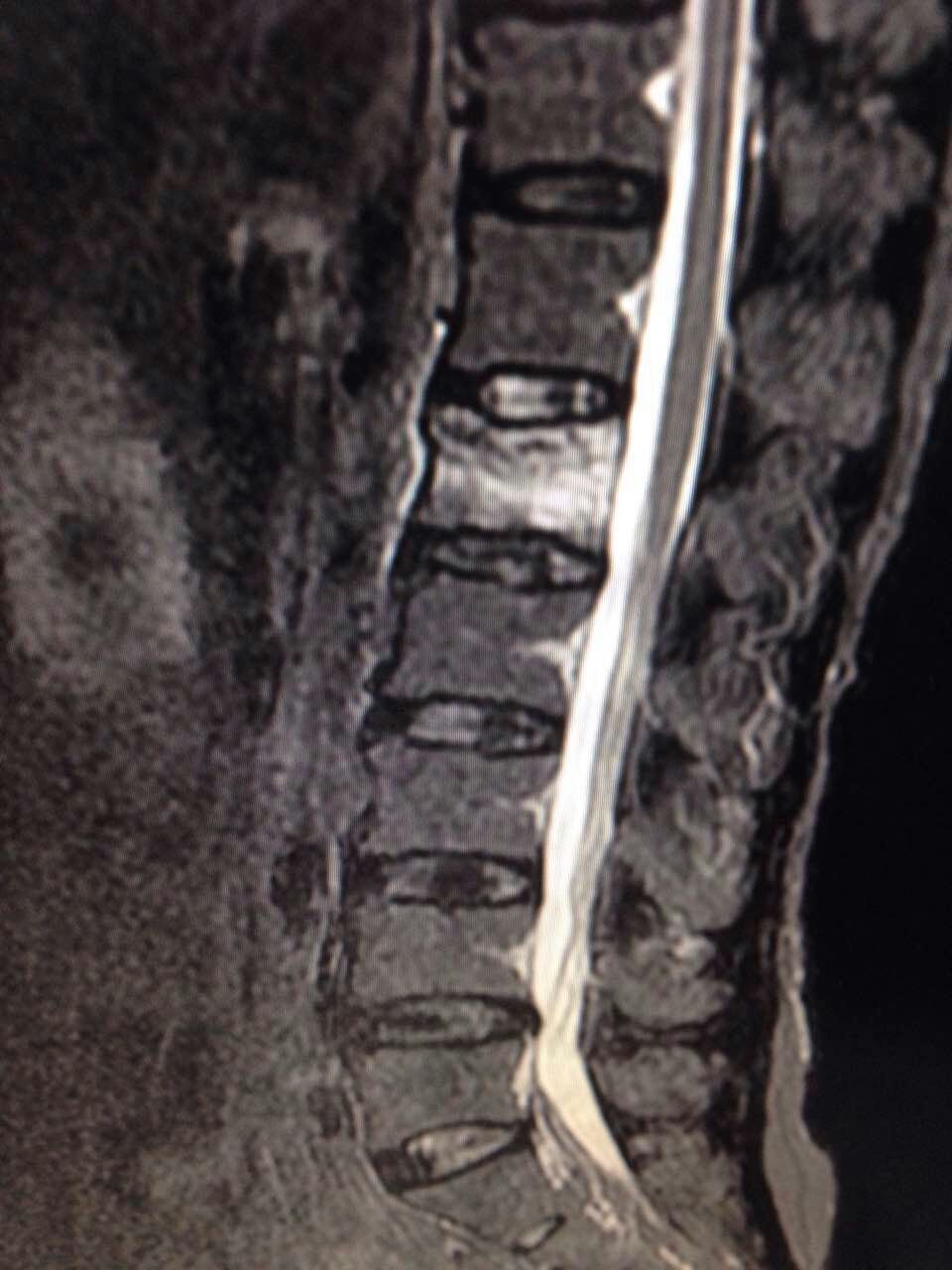 骨质疏松脊柱压缩性骨折怎么治疗,脊柱及四肢骨折的治疗决策