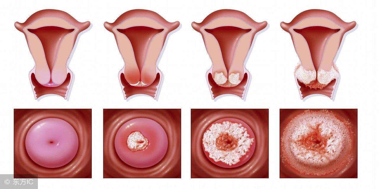 宫颈糜烂出血和宫颈癌出血的区别,如何判断是宫颈出血还是月经出血