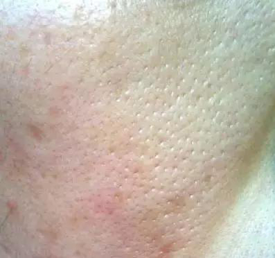 年轻女人脸上长痘是什么原因,长痘证明你还年轻