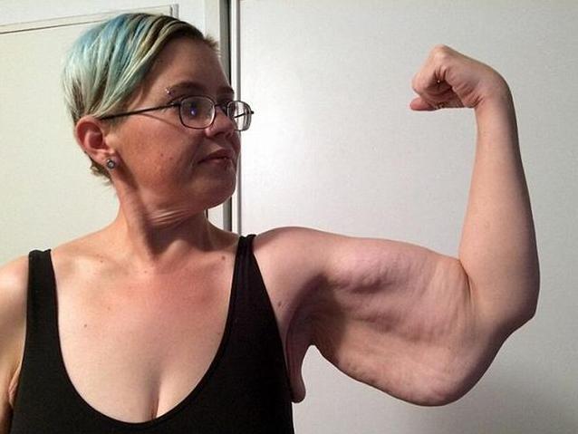 减肥后皮肤松弛靠运动可以紧致吗,胖子减肥后肚子皮肤松弛如何消除