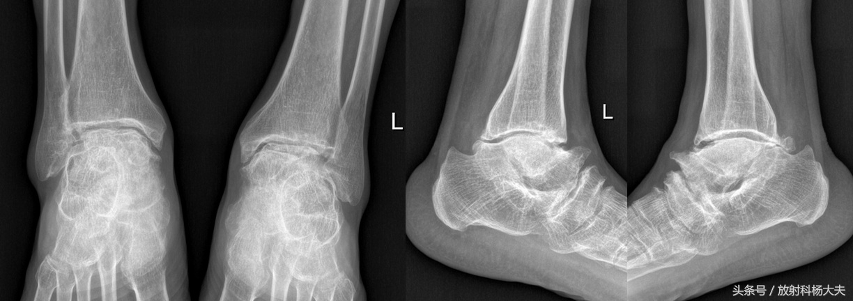 骨关节疾病是一种什么病,骨关节病是一种什么病