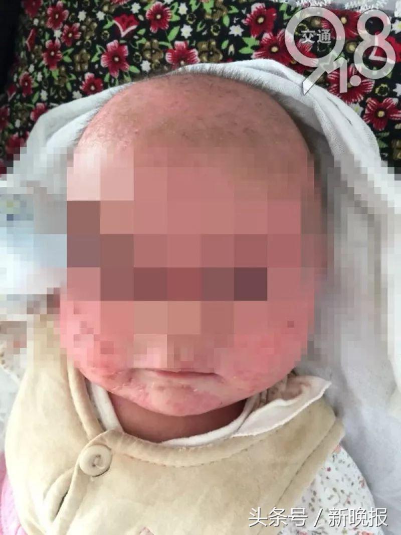 宝宝长疱疹三天自愈的最佳方法,千万别再让孩子做这几个动作了