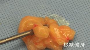 抽脂减肥的过程与效果,抽脂减肥的过程和效果