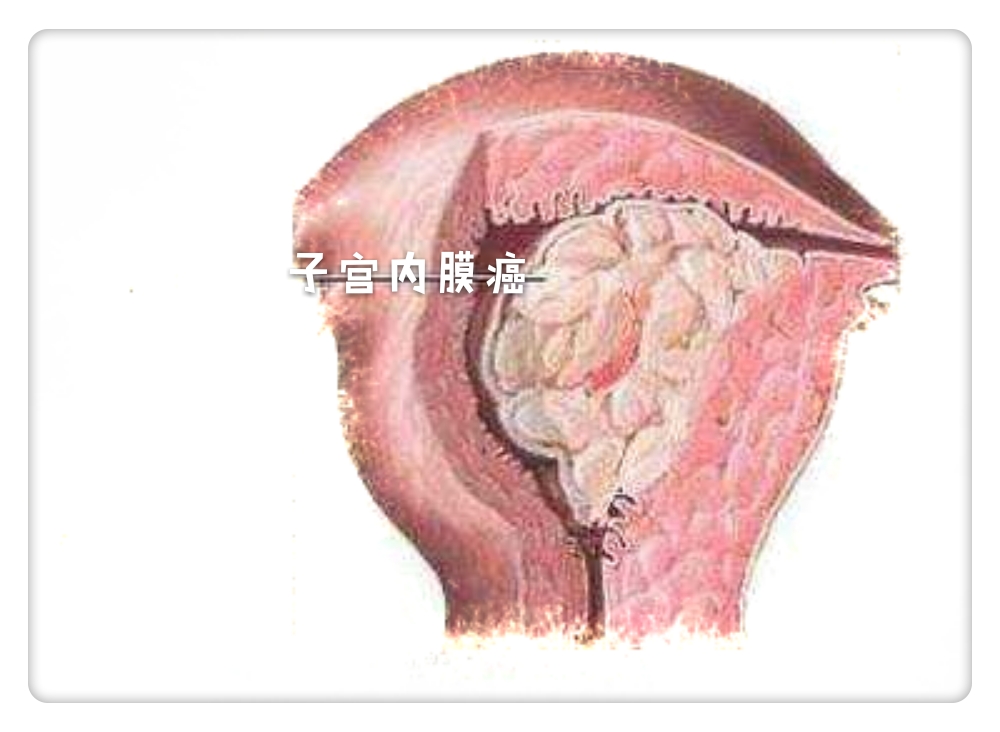 左小腹疼痛阴道流血是什么症状,小腹疼痛阴道流血是什么症状