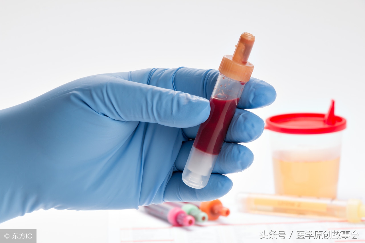 尿液颜色变红怎么回事,尿液红褐色三次又恢复正常了