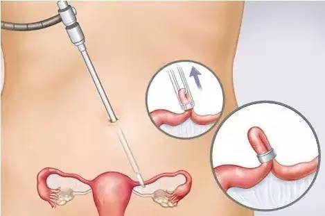 你该知道的小姿势，关于不想意外要孩子的一些运动