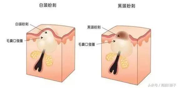 别傻了！蔡徐坤、Angelababy都根治不掉的黑头，微商神器能去除？