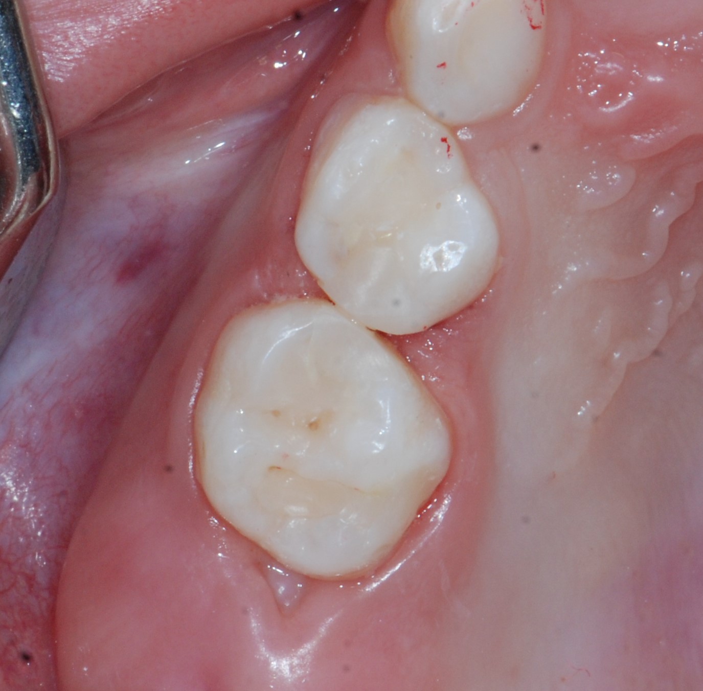 小朋友塞牙,小朋友的塞牙反复发作