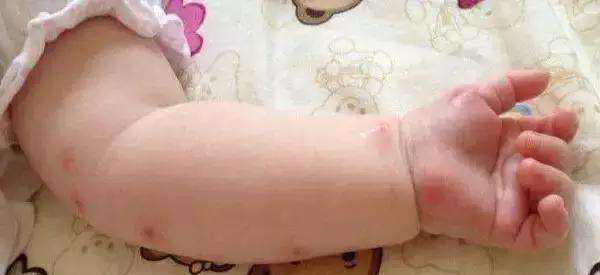 孩子被蚊子叮出大泡了怎么办,小孩被蚊子叮了大包