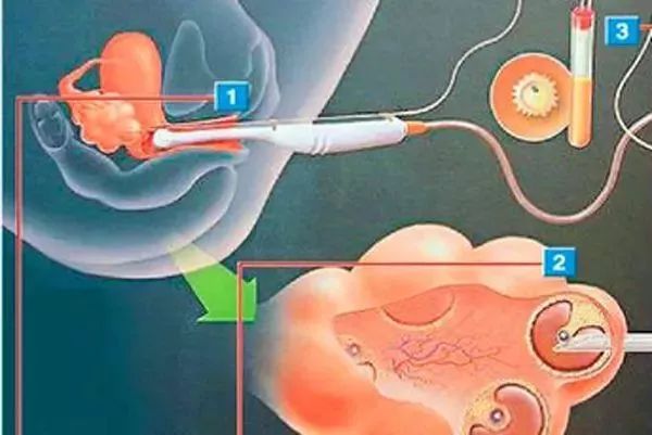 20岁女大学生捐卵事件18年,女大学生捐卵致富