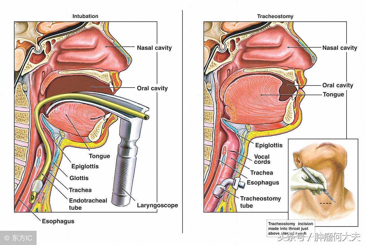 食管癌发病率高的地方,食管癌恶性程度最高的是
