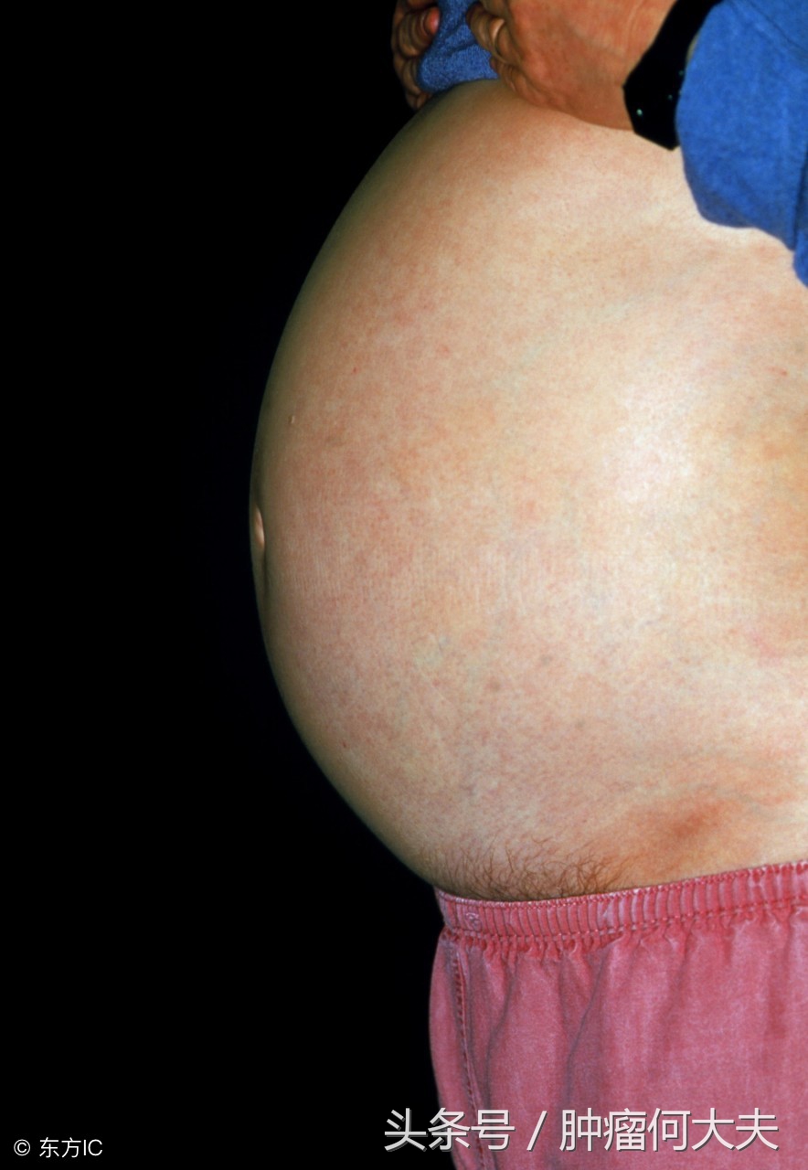 肿瘤腹腔转移有腹水能活多久,癌症晚期腹水腹腔穿刺