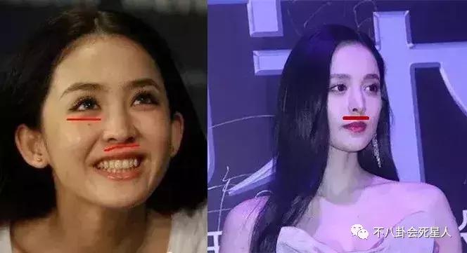 高圆圆戴牙套的脸型变化图,高圆圆戴牙套前后对比照