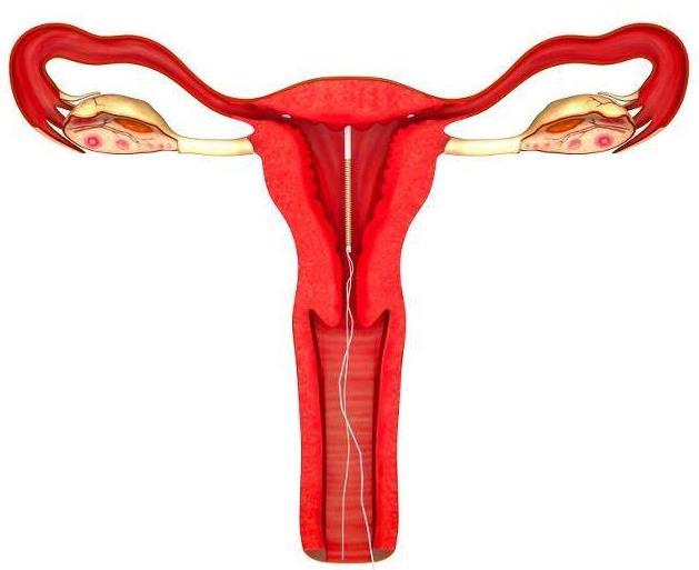 结扎跟上环哪种对身体伤害小,结扎跟上环哪个避孕效果好