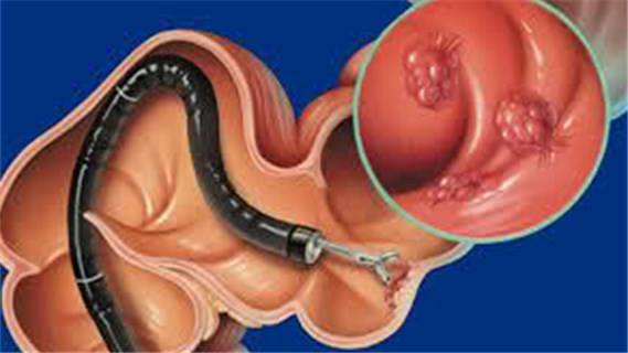 胃肠息肉手术多少钱,胃肠息肉的症状表现